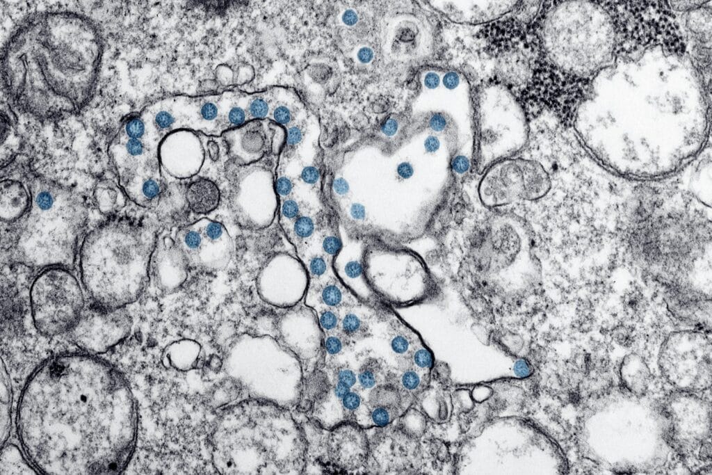 Long COVID: Esplorare il Potenziale dei Supplementi a base di Creatina per Alleviare la Stanchezza 1 Long Covid